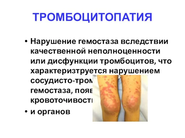 ТРОМБОЦИТОПАТИЯ Нарушение гемостаза вследствии качественной неполноценности или дисфункции тромбоцитов, что