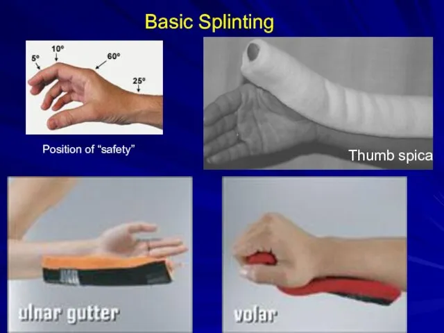Thumb spica Basic Splinting Position of “safety”