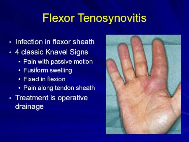 Flexor Tenosynovitis Infection in flexor sheath 4 classic Knavel Signs