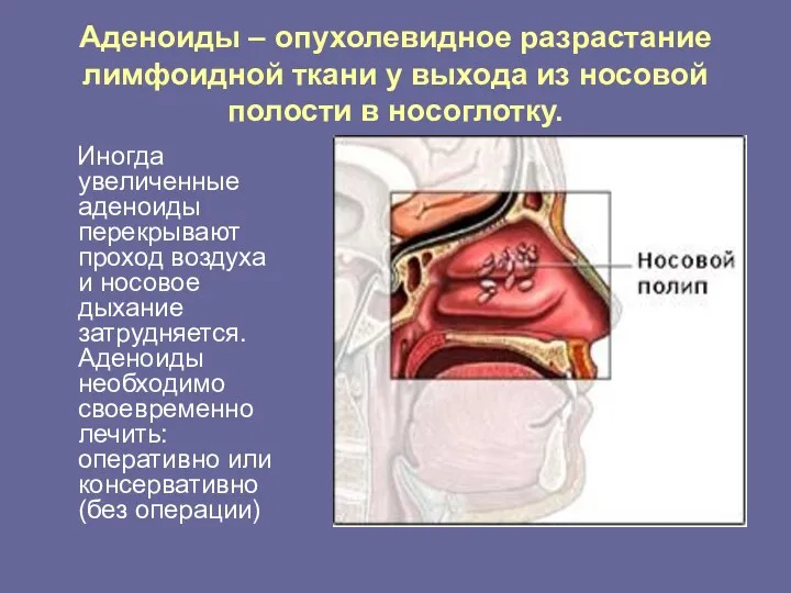 Аденоиды – опухолевидное разрастание лимфоидной ткани у выхода из носовой