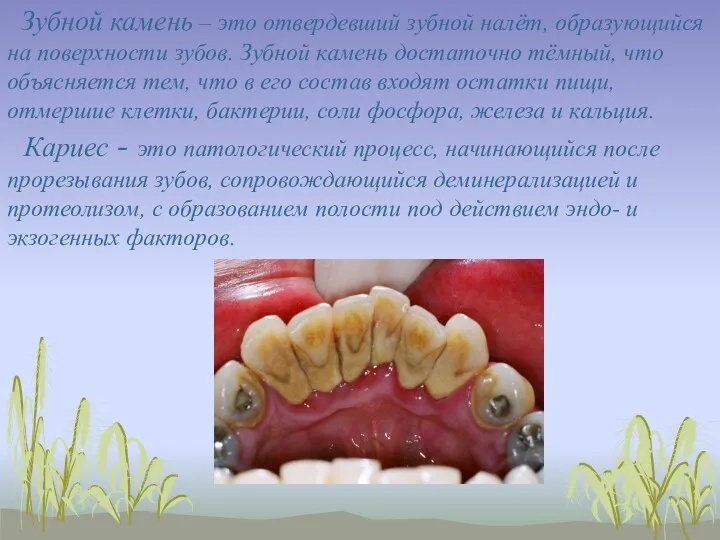 Зубной камень – это отвердевший зубной налёт, образующийся на поверхности