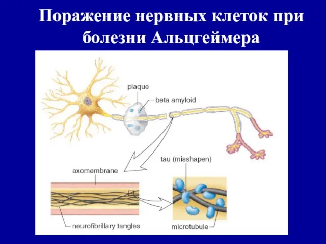 Поражение нервных клеток при болезни Альцгеймера