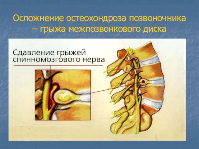 Осложнение остеохондроза позвоночника – грыжа межпозвонкового диска