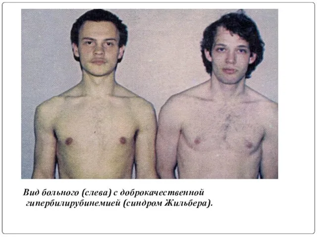 Вид больного (слева) с доброкачественной гипербилирубинемией (синдром Жильбера).