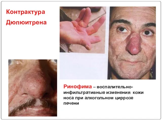 Ринофима – воспалительно-инфильтративные изменения кожи носа при алкогольном циррозе печени Контрактура Дюпюитрена