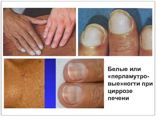 Белые или «перламутро-вые»ногти при циррозе печени