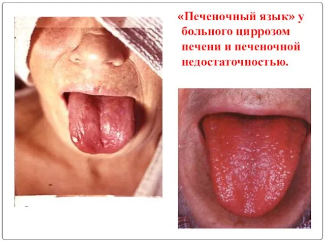 «Печеночный язык» у больного циррозом печени и печеночной недостаточностью.