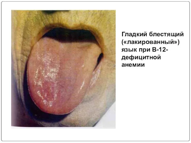 Гладкий блестящий («лакированный») язык при В-12-дефицитной анемии