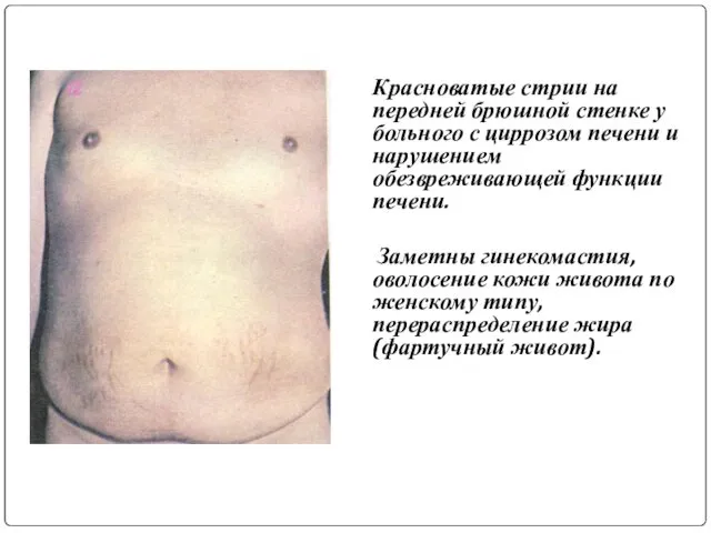 Красноватые стрии на передней брюшной стенке у больного с циррозом печени и нарушением