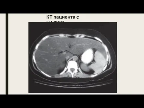 КТ пациента с НАЖБП