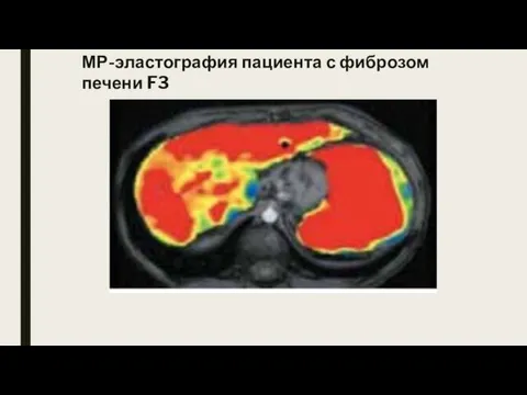 МР-эластография пациента с фиброзом печени F3