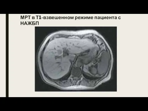 МРТ в Т1-взвешенном режиме пациента с НАЖБП