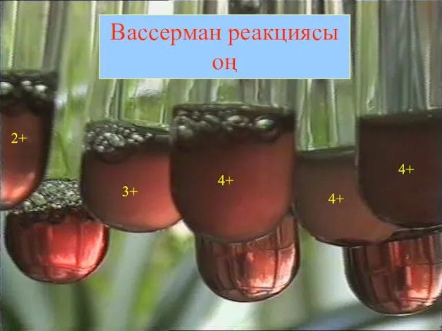 Вассерман реакциясы оң 2+ 3+ 4+ 4+ 4+