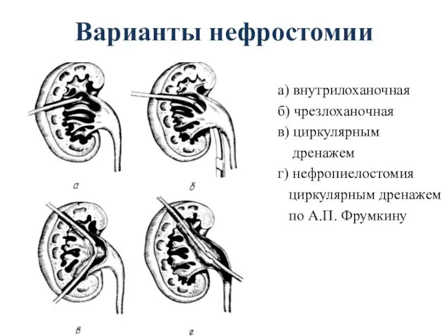 Варианты нефростомии а) внутрилоханочная б) чрезлоханочная в) циркулярным дренажем г) нефропиелостомия циркулярным дренажем по А.П. Фрумкину