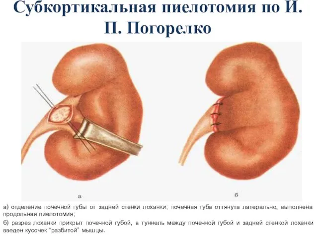 Субкортикальная пиелотомия по И.П. Погорелко а) отделение почечной губы от