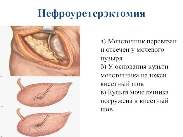 Нефроуретерэктомия а) Мочеточник перевязан и отсечен у мочевого пузыря б)