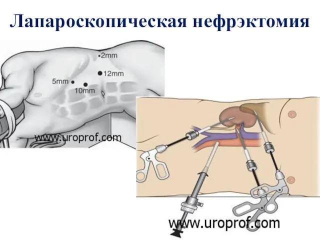 Лапароскопическая нефрэктомия