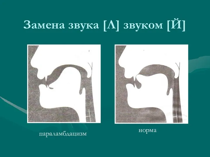 Замена звука [Л] звуком [Й] параламбдацизм норма параламбдацизм