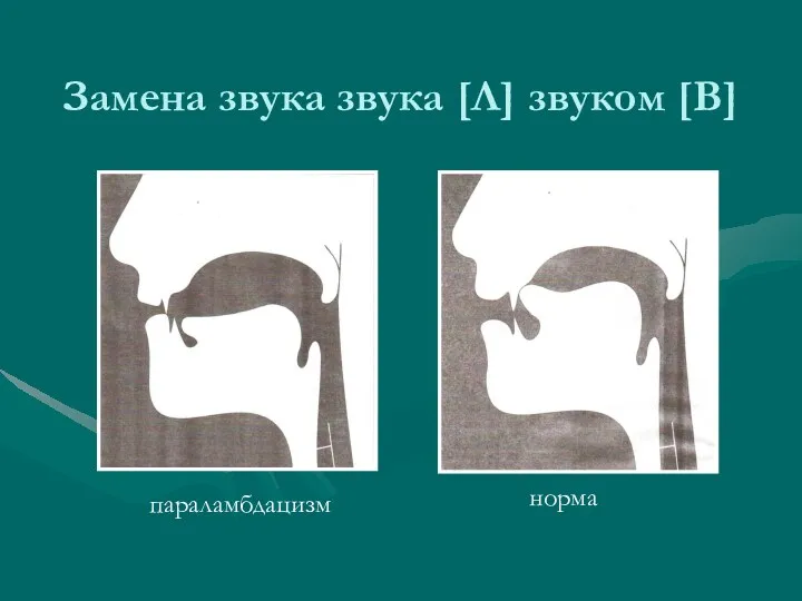 Замена звука звука [Л] звуком [В] параламбдацизм норма параламбдацизм