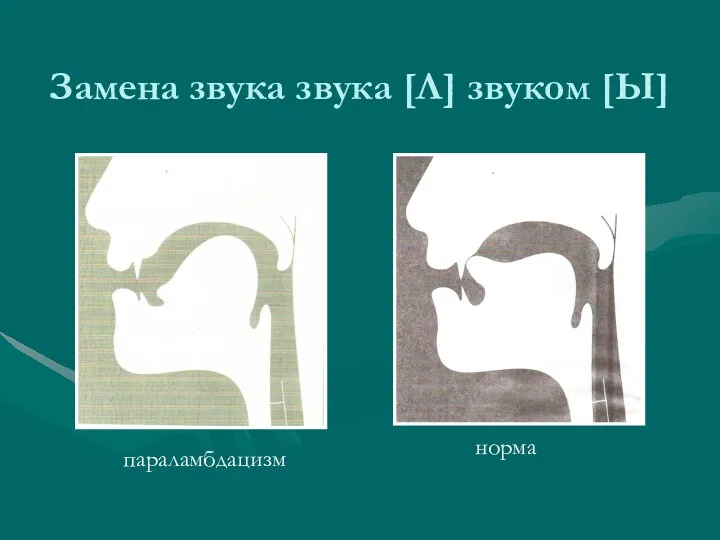 Замена звука звука [Л] звуком [Ы] параламбдацизм норма параламбдацизм