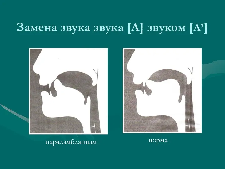 Замена звука звука [Л] звуком [Л’] параламбдацизм норма параламбдацизм