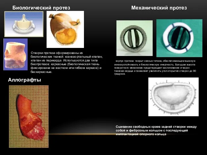 Механический протез Биологический протез Сшивание свободных краев задней створки между
