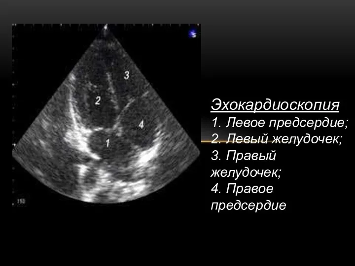 Эхокардиоскопия 1. Левое предсердие; 2. Левый желудочек; 3. Правый желудочек; 4. Правое предсердие