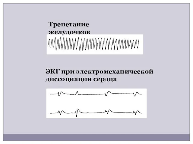 ЭКГ при электромеханической диссоциации сердца Трепетание желудочков