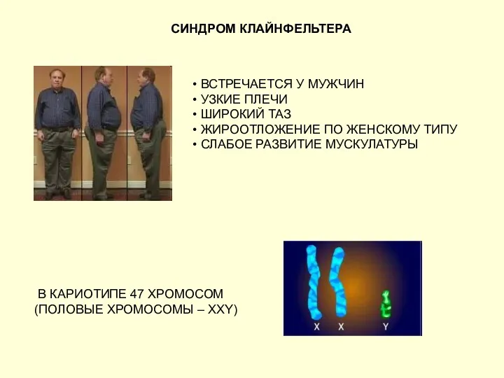 СИНДРОМ КЛАЙНФЕЛЬТЕРА ВСТРЕЧАЕТСЯ У МУЖЧИН УЗКИЕ ПЛЕЧИ ШИРОКИЙ ТАЗ ЖИРООТЛОЖЕНИЕ