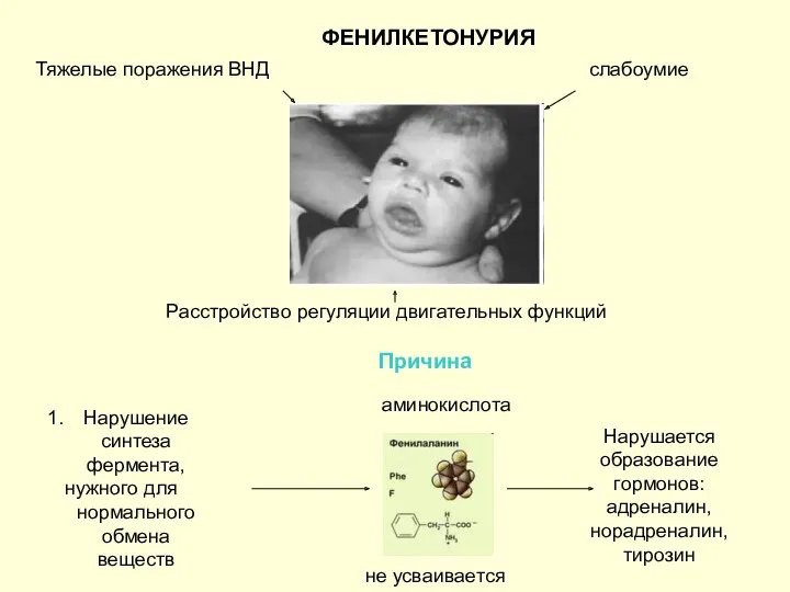 ФЕНИЛКЕТОНУРИЯ Тяжелые поражения ВНД слабоумие Расстройство регуляции двигательных функций Причина