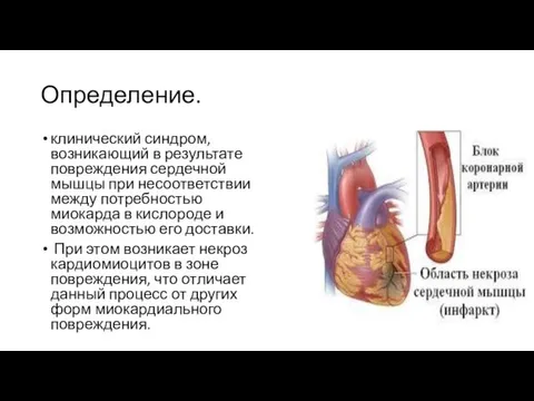 Определение. клинический синдром, возникающий в результате повреждения сердечной мышцы при несоответствии между потребностью