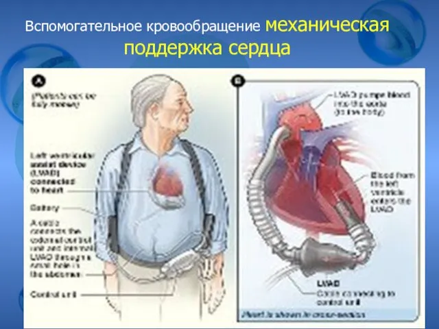 Вспомогательное кровообращение механическая поддержка сердца