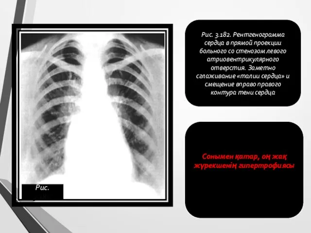 Рис. 3.182. Рентгенограмма сердца в прямой проекции больного со стенозом левого атриовентрикулярного отверстия.