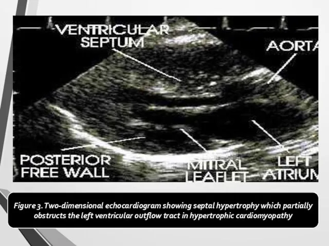 Figure 3. Two-dimensional echocardiogram showing septal hypertrophy which partially obstructs the left ventricular