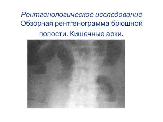 Рентгенологическое исследование Обзорная рентгенограмма брюшной полости. Кишечные арки.