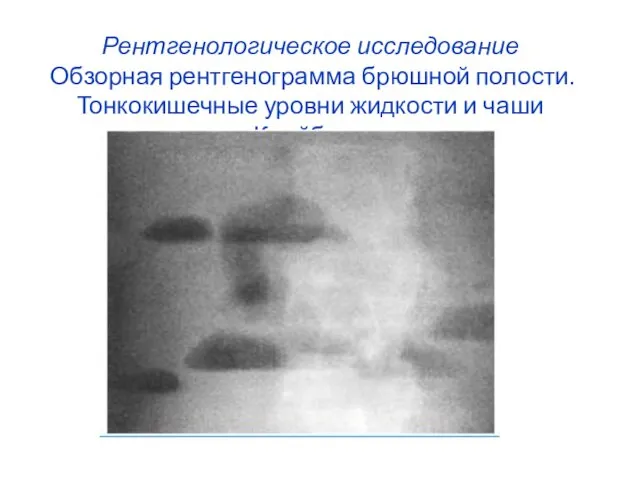 Рентгенологическое исследование Обзорная рентгенограмма брюшной полости. Тонкокишечные уровни жидкости и чаши Клойбера