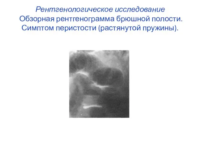 Рентгенологическое исследование Обзорная рентгенограмма брюшной полости. Симптом перистости (растянутой пружины).