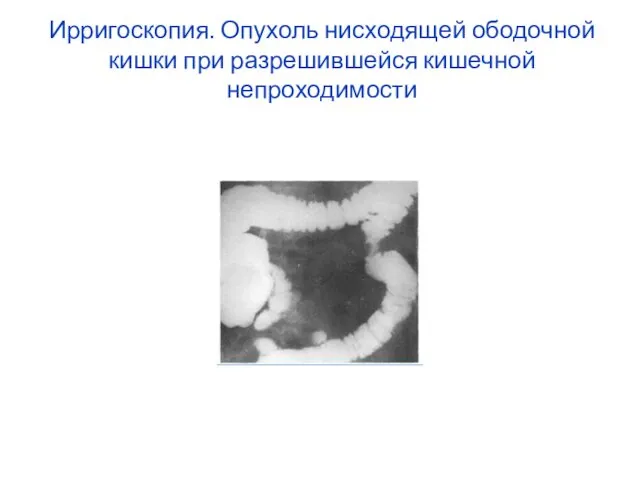 Ирригоскопия. Опухоль нисходящей ободочной кишки при разрешившейся кишечной непроходимости