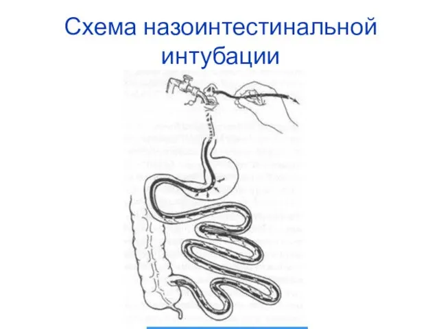 Схема назоинтестинальной интубации