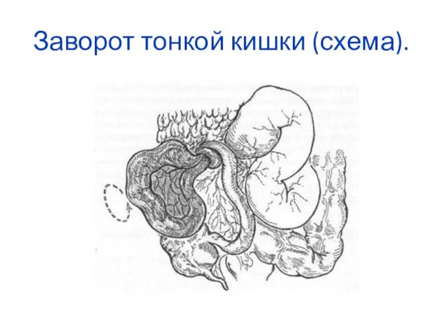 Заворот тонкой кишки (схема).