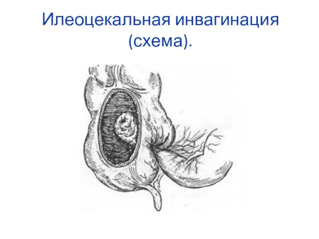 Илеоцекальная инвагинация (схема).