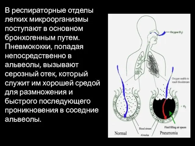 В респираторные отделы легких микроорганизмы поступают в основном бронхогенным путем.