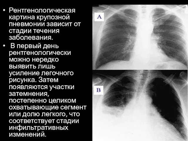 Рентгенологическая картина крупозной пневмонии зависит от стадии течения заболевания. В