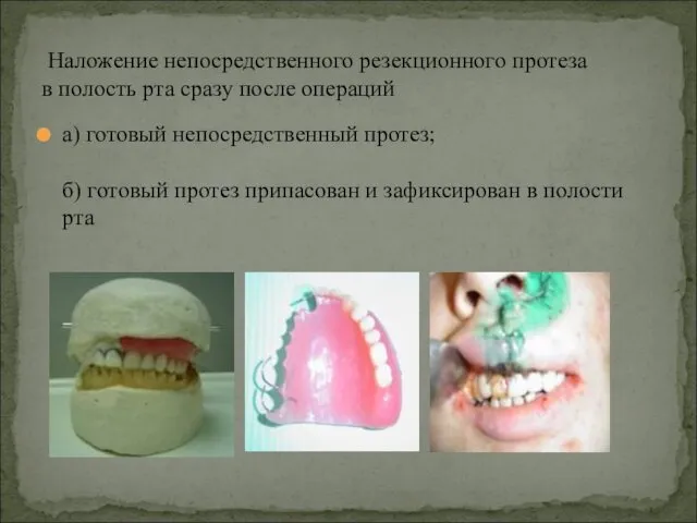 а) готовый непосредственный протез; б) готовый протез припасован и зафиксирован