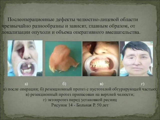 Послеоперационные дефекты челюстно-лицевой области чрезвычайно разнообразны и зависят, главным образом,