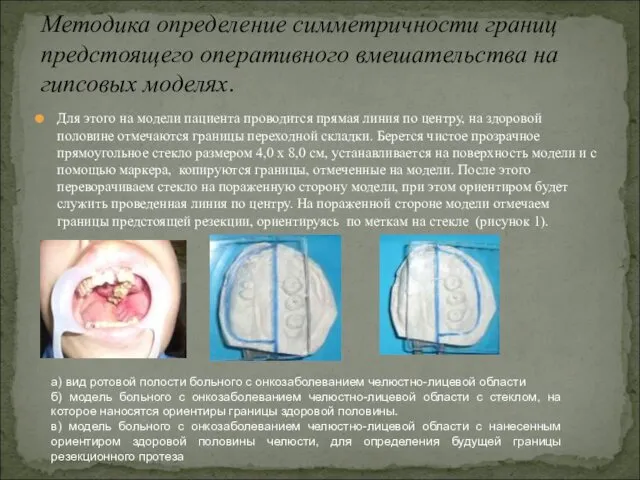 Для этого на модели пациента проводится прямая линия по центру,