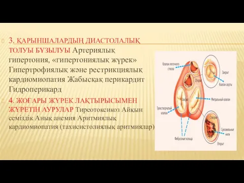 3. ҚАРЫНШАЛАРДЫҢ ДИАСТОЛАЛЫҚ ТОЛУЫ БҰЗЫЛУЫ Артериялық гипертония, «гипертониялық жүрек» Гипертрофиялық