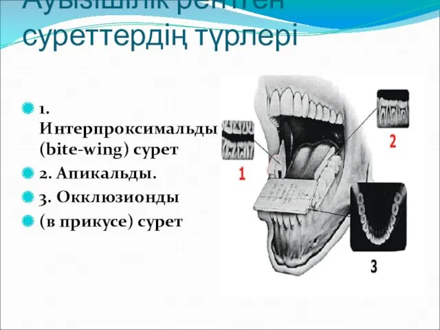 Ауызішілік рентген суреттердің түрлері 1.Интерпроксимальды (bite-wing) сурет 2. Апикальды. 3. Окклюзионды (в прикусе) сурет