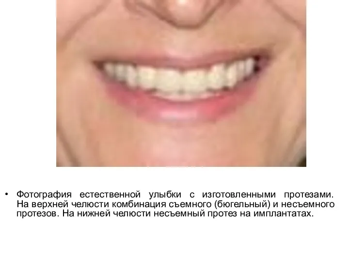 Фотография естественной улыбки с изготовленными протезами. На верхней челюсти комбинация