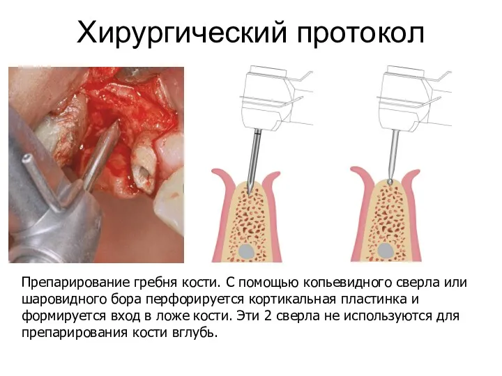 Хирургический протокол Препарирование гребня кости. С помощью копьевидного сверла или